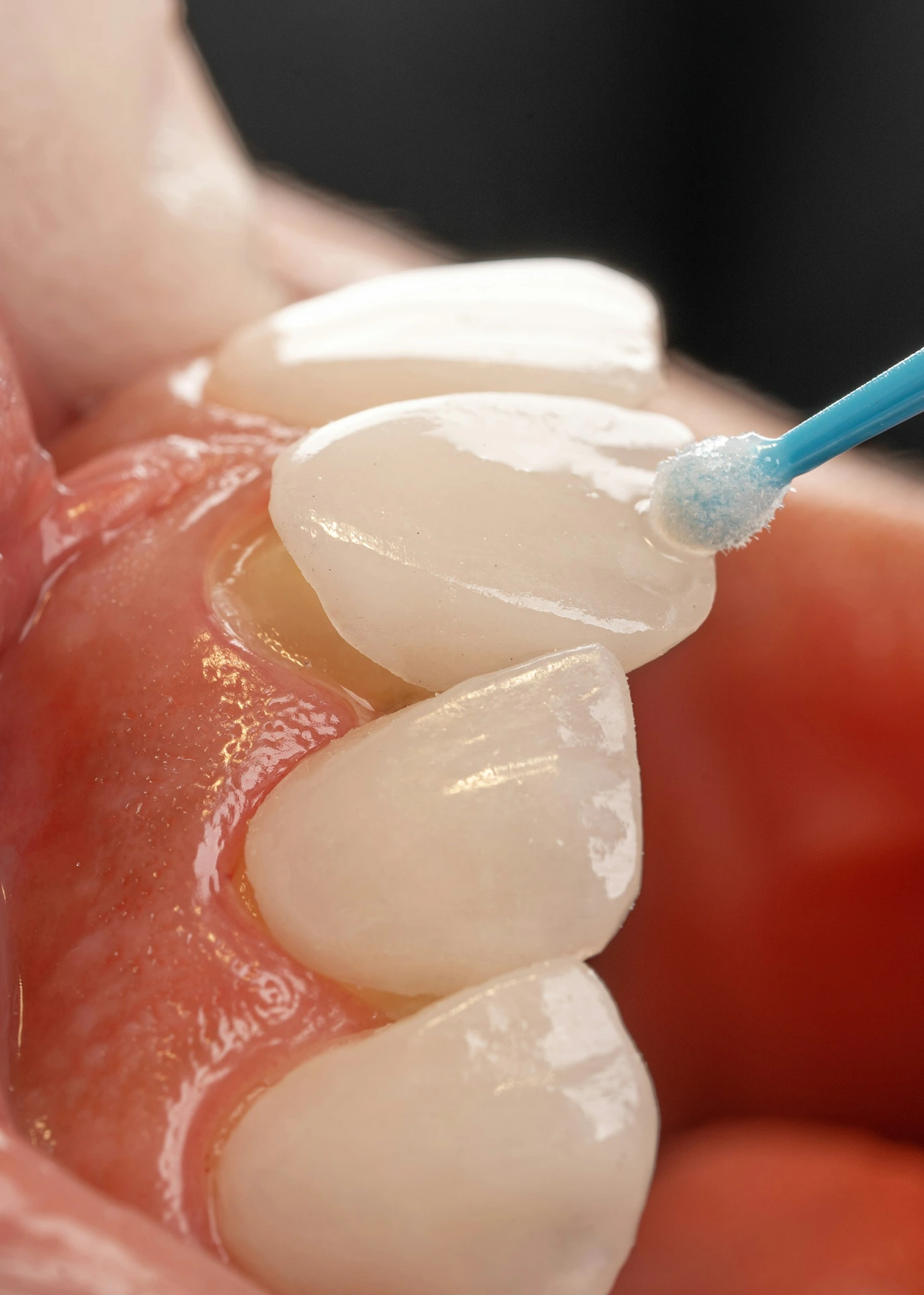 Veneers result